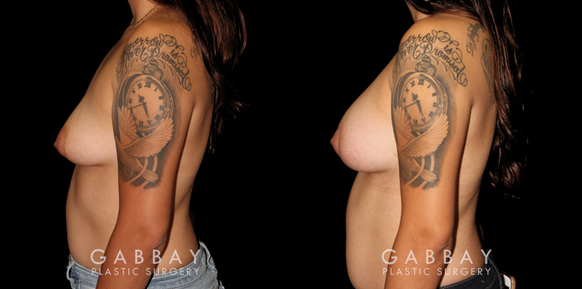 Before-and-after photos for patient with unilateral breast lift and bilateral breast augmentation. The improved symmetry restored a more natural look to the breasts with even nipple position.