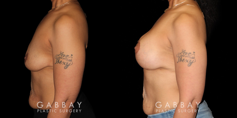 Patient with combined breast lift and breast augmentation using saline implants. Patient fully recovered from the combination procedure with excellent results.