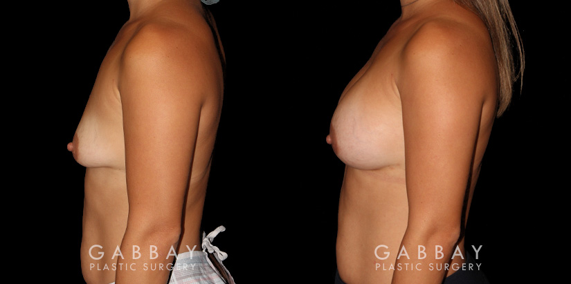 Silicone breast implants combined with a breast lift following complete procedure recovery. Patient recovered smoothly from the combination surgery without complications.
