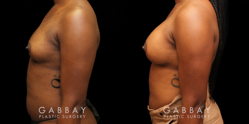 Patient before and after receiving silicone implants to increase breast roundness and overall volume. Results are shown following complete, smoother recovery.