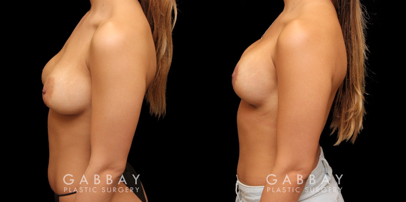 Before-and-after photos for patient who had removal and replacement of silicone implants (capsulorrhaphy). Final procedure included a breast lift to restore the position of the breasts.