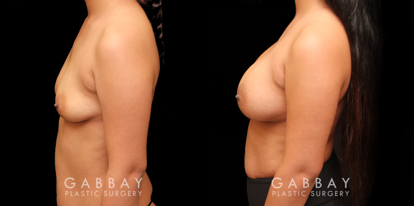 Photos for female patient before and after silicone implant procedure. Note the robust increase in breast size while continuing to match her body's aesthetic for an aligned appearance.