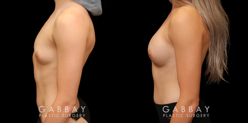 Patient wanted very mild breast augmentation to improve the roundness and curve of breasts. Results show increase from minimal breast shape to a gentle rounding slope to the breasts.