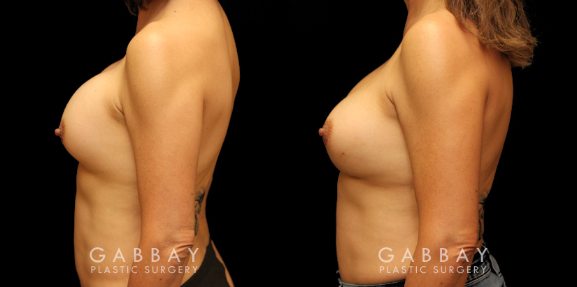 Patient before-and-after photos for implant removal and replacement procedure. This revision breast augmentation went well and patient was satisfied with how her new implants looked and felt.