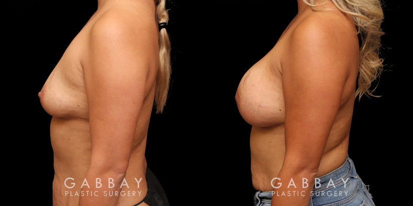 Before-and-after photos for female patient with breast augmentation. Classic results show improved size and volume of breasts with enhanced roundness from each angle.