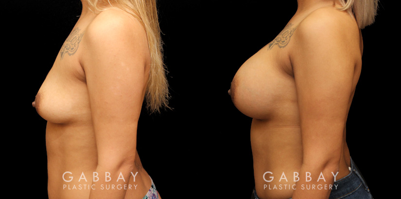 Silicone implant breast augmentation photos showing before and after the procedure (post complete recovery). Patient breasts are demonstrably rounder with a balanced volume increase that suits her body shape.