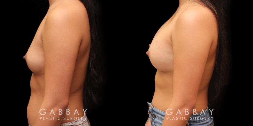 Photos of breast augmentation patient results, including before procedure and after once the patient fully recovered. Increased breast roundness allowed for the patient to see an unique aesthetic.