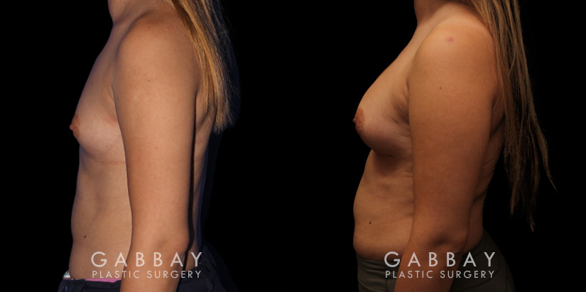 Patient wanted to achieve notable breast enlargement without passing a natural boundary. So we used mild silicone implants to boost breast contour and roundness while keeping the results looking natural.