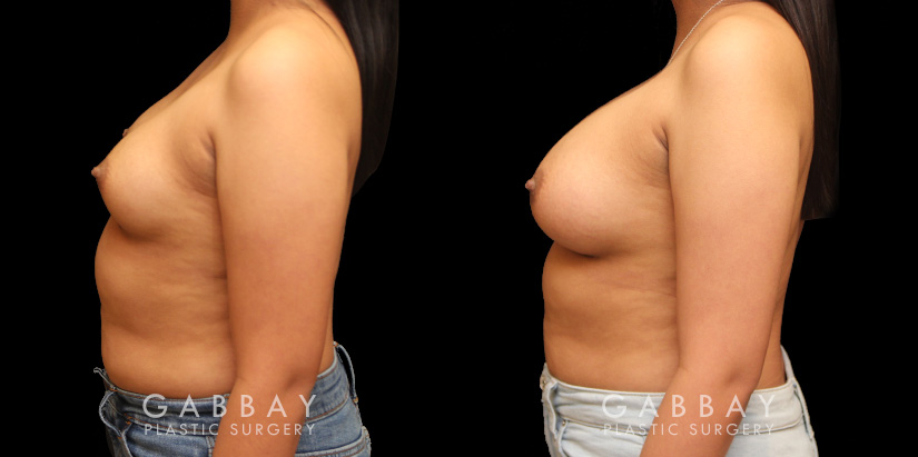 Using silicone implants, patient wanted a mild boost to breast volume without dramatic results. The final look has enhanced roundness while keeping to the patient’s natural breast shape and position before the procedure.