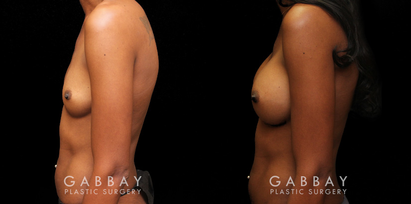 Patient before-and-after photos for breast augmentation with silicone implants. Patient increased cup size while maintaining a natural, balanced look to the breasts.