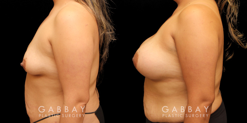 Silicone implant results. Patient increased breast size and used the implants to reduce breast drooping as well, without the need for mastopexy in addition.