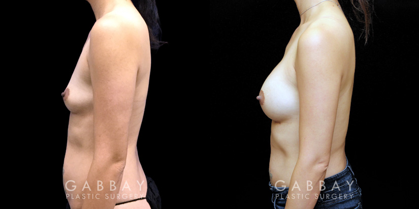 Breast Augmentation – Silicone