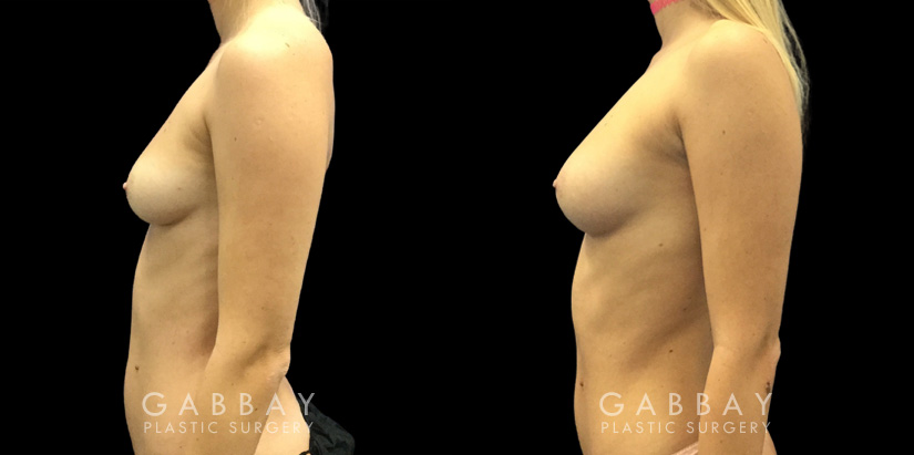 Patient 06 Left Side View Breast Fat Grafting Gabbay Plastic Surgery