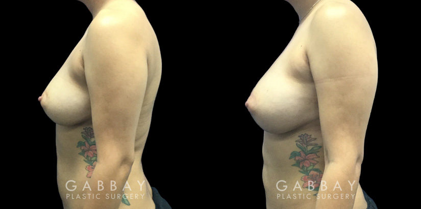 Patient 08 Left Side View Breast Fat Grafting Gabbay Plastic Surgery