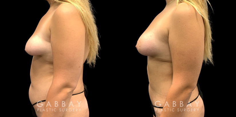 Patient 11 Left Side View Breast Fat Grafting Gabbay Plastic Surgery