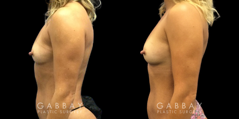 Patient 12 Left Side View Breast Fat Grafting Gabbay Plastic Surgery
