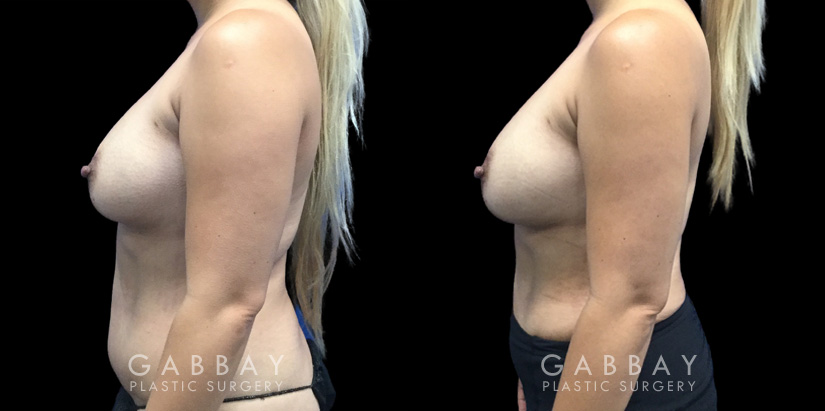 Patient 13 Left Side View Breast Fat Grafting Gabbay Plastic Surgery