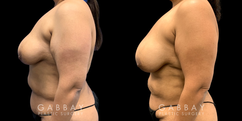 Patient 15 Left Side View Breast Fat Grafting Gabbay Plastic Surgery