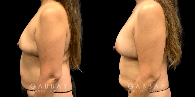 Patient 16 Left Side View Breast Fat Grafting Gabbay Plastic Surgery