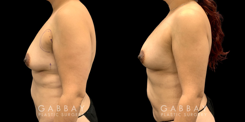 Patient 17 Left Side View Breast Fat Grafting Gabbay Plastic Surgery