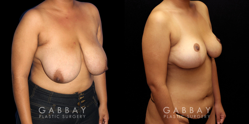 Patient 03 3/4th Right Side View Mastopexy Gabbay Plastic Surgery