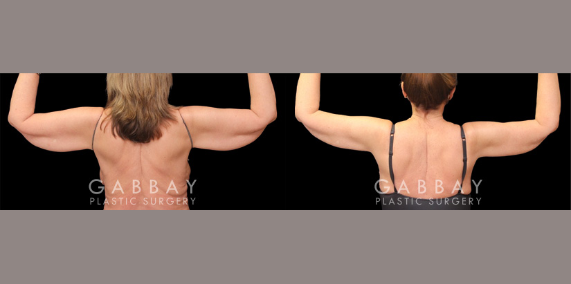 Arm lift with lipo