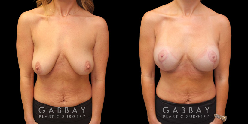 Patient 25 Front View Breast Augpexy Gabbay Plastic Surgery