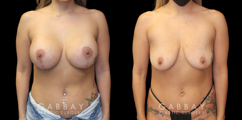 Patient 26 Front View Breast Augpexy Gabbay Plastic Surgery