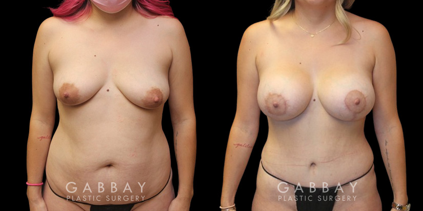 Patient 27 Front View Breast Augpexy Gabbay Plastic Surgery