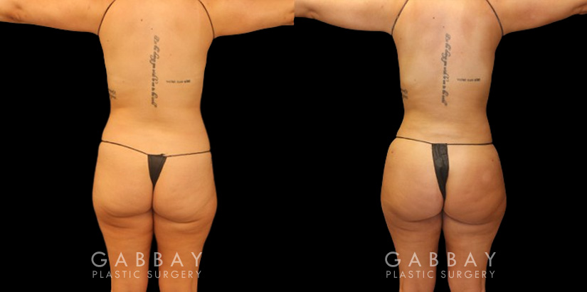Before and after of 360 liposuction and BBL combination, focusing on removal of fat on the waist and back with abdominal contouring. Transferred fat to butt resulted in a rounder position with a natural feel and shape ideal for the patient's body type. The patient's Brazilian butt lift recovery went smoothly and results settled well following the recovery period.