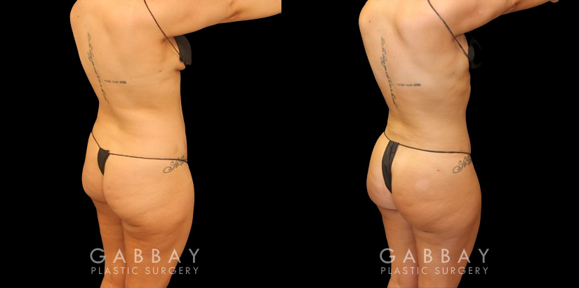 Before and after of 360 liposuction and BBL combination, focusing on removal of fat on the waist and back with abdominal contouring. Transferred fat to butt resulted in a rounder position with a natural feel and shape ideal for the patient's body type. The patient's Brazilian butt lift recovery went smoothly and results settled well following the recovery period.