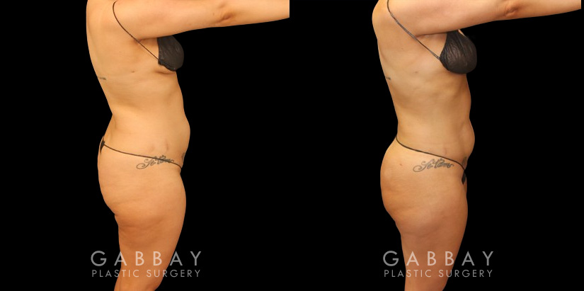 Before and after of 360 liposuction and BBL combination, focusing on removal of fat on the waist and back with abdominal contouring. Transferred fat to butt resulted in a rounder position with a natural feel and shape ideal for the patient's body type. The patient's Brazilian butt lift recovery went smoothly and results settled well following the recovery period.