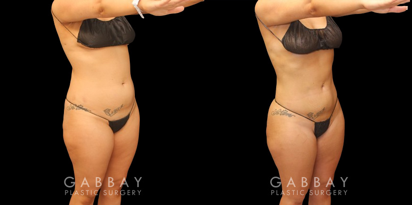 Before and after of 360 liposuction and BBL combination, focusing on removal of fat on the waist and back with abdominal contouring. Transferred fat to butt resulted in a rounder position with a natural feel and shape ideal for the patient's body type. The patient's Brazilian butt lift recovery went smoothly and results settled well following the recovery period.