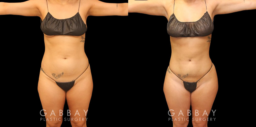 Before and after of 360 liposuction and BBL combination, focusing on removal of fat on the waist and back with abdominal contouring. Transferred fat to butt resulted in a rounder position with a natural feel and shape ideal for the patient's body type. The patient's Brazilian butt lift recovery went smoothly and results settled well following the recovery period.