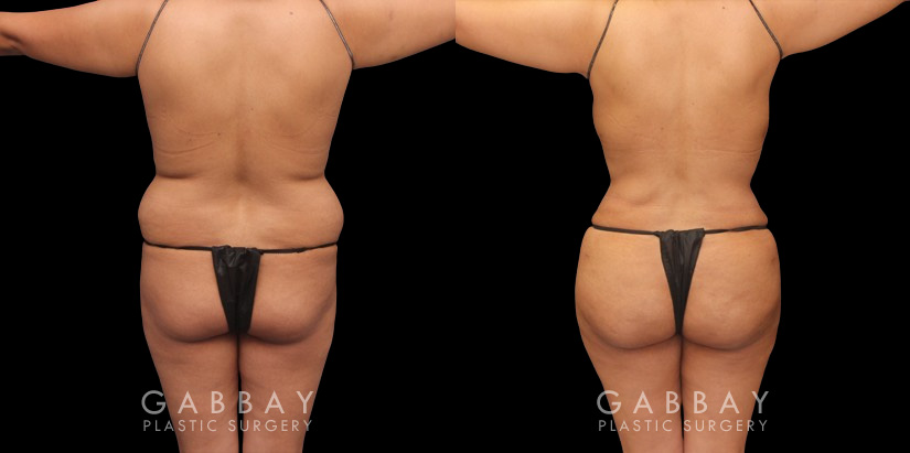 Before and after photos showing a female patient with substantial liposuction and fat transferred from around the abdomen, waist, and back to buttocks. Full and round shape improvement to the buttocks (without butt implants) by a leading Brazilian butt lift specialist and dramatic body contouring through 360 liposuction.