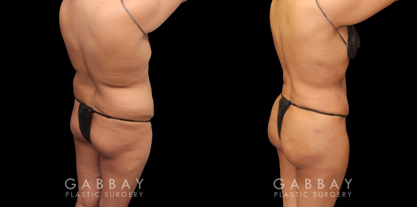 Before and after photos showing a female patient with substantial liposuction and fat transferred from around the abdomen, waist, and back to buttocks. Full and round shape improvement to the buttocks (without butt implants) by a leading Brazilian butt lift specialist and dramatic body contouring through 360 liposuction.