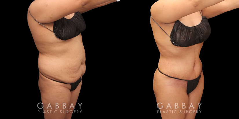 Before and after photos showing a female patient with substantial liposuction and fat transferred from around the abdomen, waist, and back to buttocks. Full and round shape improvement to the buttocks (without butt implants) by a leading Brazilian butt lift specialist and dramatic body contouring through 360 liposuction.