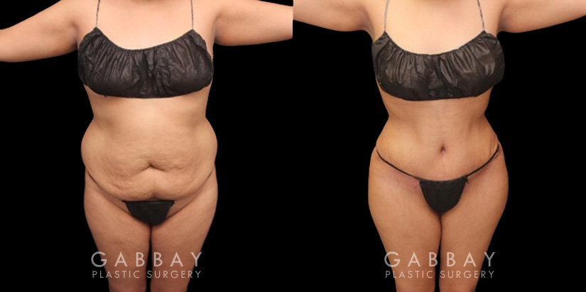 Before and after photos showing a female patient with substantial liposuction and fat transferred from around the abdomen, waist, and back to buttocks. Full and round shape improvement to the buttocks (without butt implants) by a leading Brazilian butt lift specialist and dramatic body contouring through 360 liposuction.