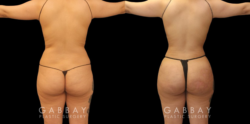 Before and after the front, silhouette, and back after Brazilian butt lift surgery after fat transfer to butt has settled to final results. Patient achieved a contoured waist through full 360 liposuction for slimmer middle emphasizing the well-rounded butt shape. Post-op recovery for BBL went well and the patient saw excellent retention of injected fat.