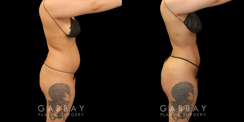 Before and after the front, silhouette, and back after Brazilian butt lift surgery after fat transfer to butt has settled to final results. Patient achieved a contoured waist through full 360 liposuction for slimmer middle emphasizing the well-rounded butt shape. Post-op recovery for BBL went well and the patient saw excellent retention of injected fat.