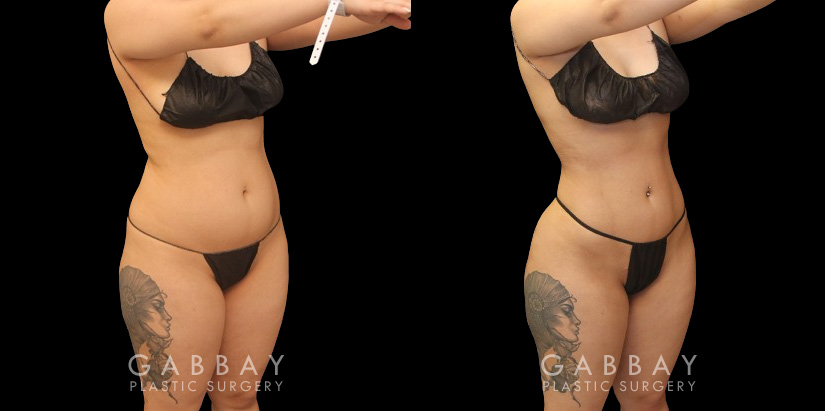Before and after the front, silhouette, and back after Brazilian butt lift surgery after fat transfer to butt has settled to final results. Patient achieved a contoured waist through full 360 liposuction for slimmer middle emphasizing the well-rounded butt shape. Post-op recovery for BBL went well and the patient saw excellent retention of injected fat.