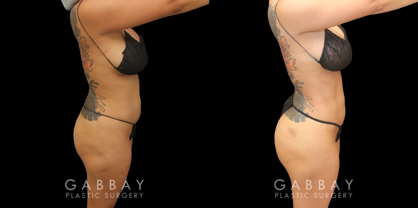 Post-op photos of BBL surgery combined with body contouring liposuction of waist, back, and abdomen. 360 fat removal resulted in a slimmer waist contour all around, enhancing figure to show a dynamic volume increase of the butt with lifted position while standing in a relaxed posture. Patient reported a comfortable recovery without complications.