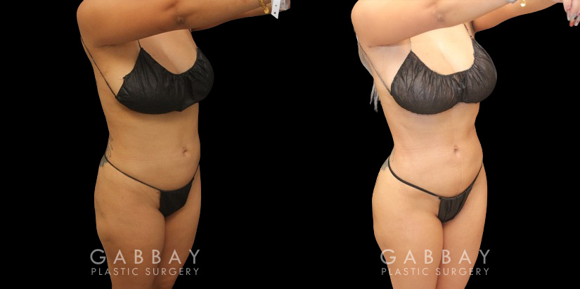 Post-op photos of BBL surgery combined with body contouring liposuction of waist, back, and abdomen. 360 fat removal resulted in a slimmer waist contour all around, enhancing figure to show a dynamic volume increase of the butt with lifted position while standing in a relaxed posture. Patient reported a comfortable recovery without complications.