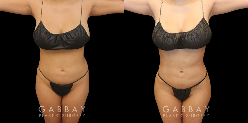 Post-op photos of BBL surgery combined with body contouring liposuction of waist, back, and abdomen. 360 fat removal resulted in a slimmer waist contour all around, enhancing figure to show a dynamic volume increase of the butt with lifted position while standing in a relaxed posture. Patient reported a comfortable recovery without complications.