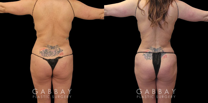 Before and after photos of female patient with butt augmentation through fat transfer. Liposuction focused on the mid and upper waist and abdomen, adapting to the patient's body shape for optimal results. Transferred fat resulted in a lifted shape to the buttocks with increased roundness following the full settling of the transferred fat.