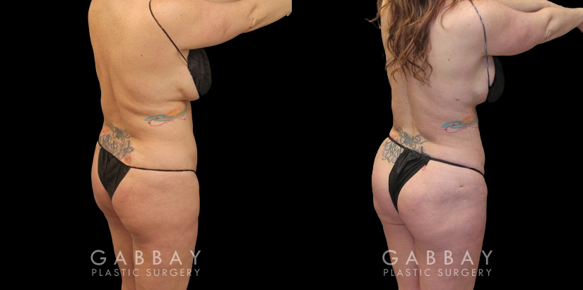 Before and after photos of female patient with butt augmentation through fat transfer. Liposuction focused on the mid and upper waist and abdomen, adapting to the patient's body shape for optimal results. Transferred fat resulted in a lifted shape to the buttocks with increased roundness following the full settling of the transferred fat.