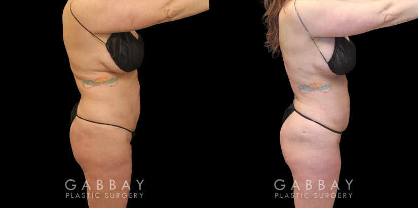 Before and after photos of female patient with butt augmentation through fat transfer. Liposuction focused on the mid and upper waist and abdomen, adapting to the patient's body shape for optimal results. Transferred fat resulted in a lifted shape to the buttocks with increased roundness following the full settling of the transferred fat.
