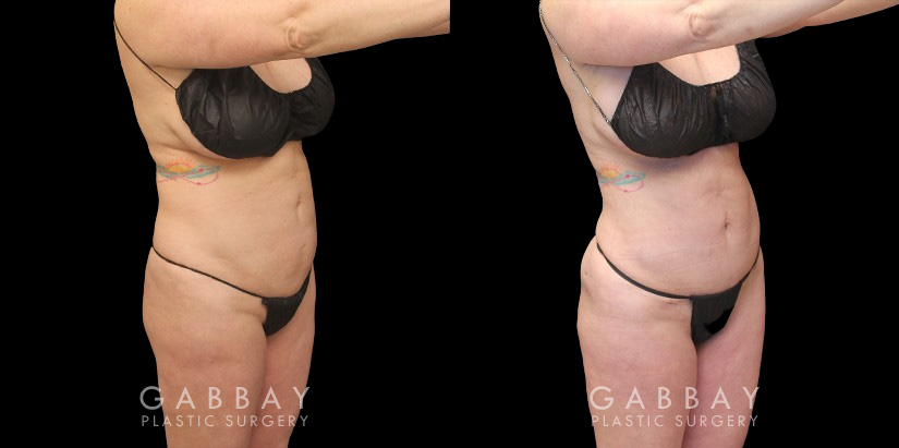 Before and after photos of female patient with butt augmentation through fat transfer. Liposuction focused on the mid and upper waist and abdomen, adapting to the patient's body shape for optimal results. Transferred fat resulted in a lifted shape to the buttocks with increased roundness following the full settling of the transferred fat.