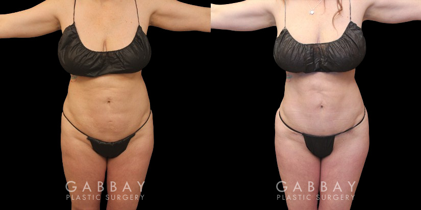 Before and after photos of female patient with butt augmentation through fat transfer. Liposuction focused on the mid and upper waist and abdomen, adapting to the patient's body shape for optimal results. Transferred fat resulted in a lifted shape to the buttocks with increased roundness following the full settling of the transferred fat.