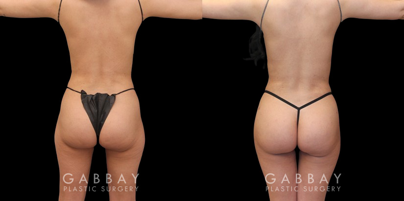 Post-op photos of mid-30s female patient for mini BBL surgery. As a mini BBL, precise liposuction resulting in enhanced body sculpting with a subtle yet marked increase in butt size, shape, and volume. Almost perfectly rounded buttocks resulted after fat settled for the patient's final results. Note the increase in abdominal contour from front and side views.